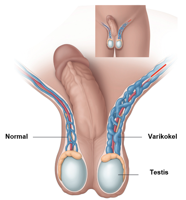 varikokel